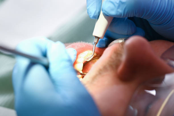 Best Broken or Cracked Tooth Emergency Dentist in Denton, NC