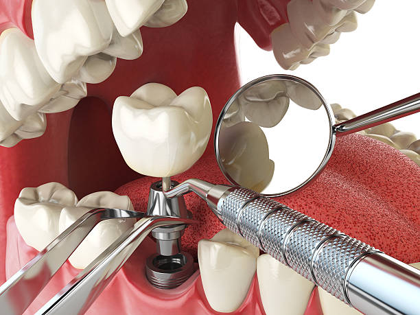 Best Emergency Root Canal Treatment in Denton, NC